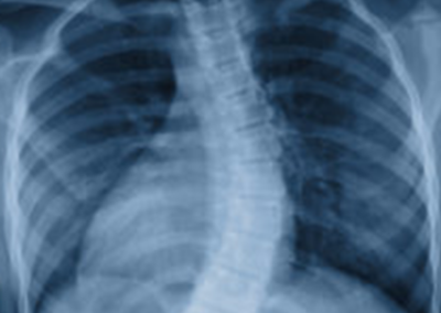 Subluxation