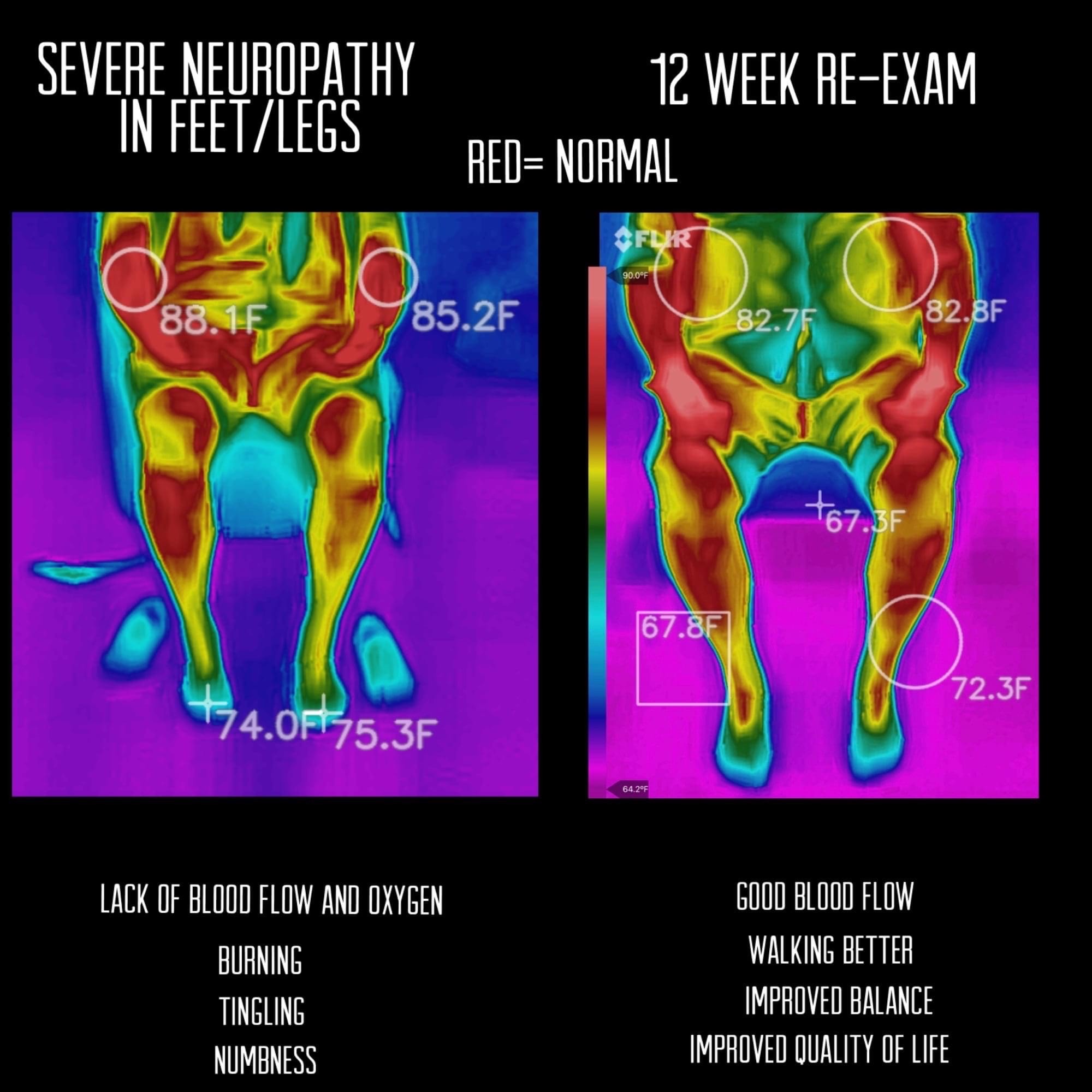 Neuropathy Thermal Image
